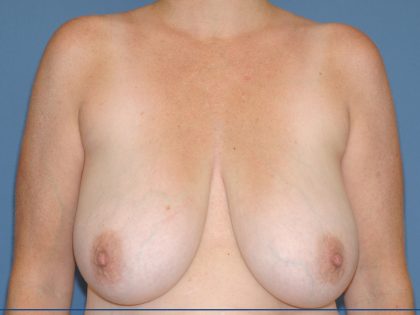 Breast Reduction Before & After Patient #3513
