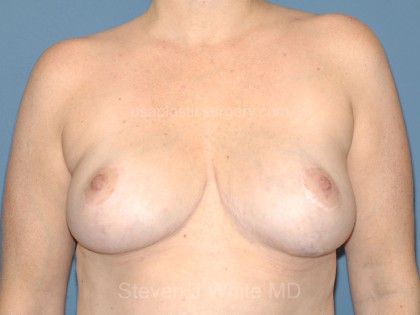 Breast Reduction Before & After Patient #3513