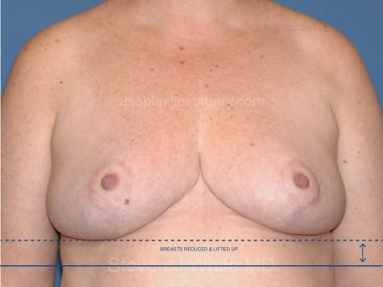 Breast Reduction Before & After Patient #3514