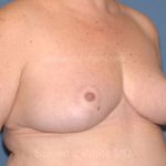 Breast Reduction Before & After Patient #3514