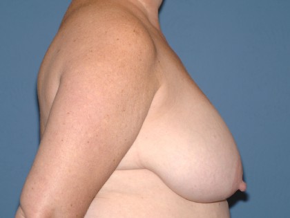 Breast Reduction Before & After Patient #3514