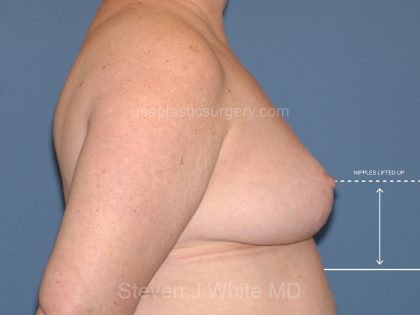 Breast Reduction Before & After Patient #3514