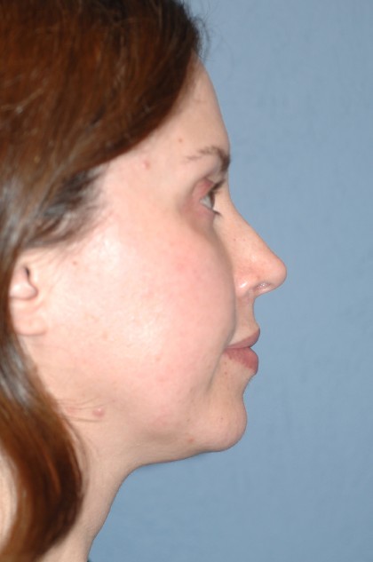 Nose Surgery - Rhinoplasty - Revision Before & After Patient #4087