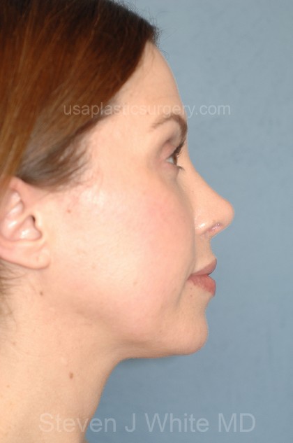 Nose Surgery - Rhinoplasty - Revision Before & After Patient #4087