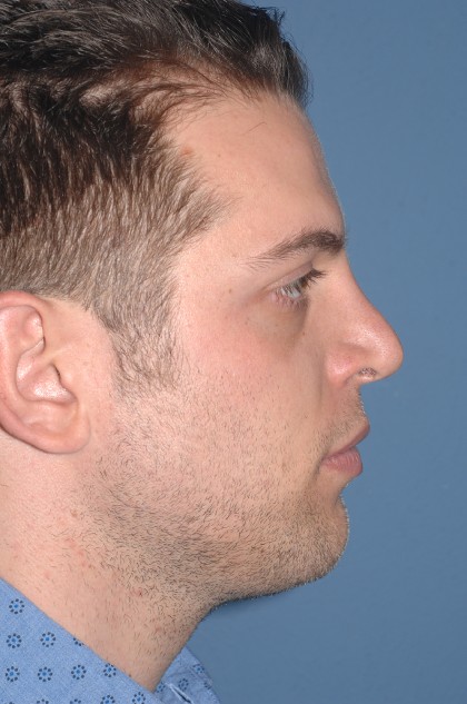 Nose Surgery - Rhinoplasty - Revision Before & After Patient #4088