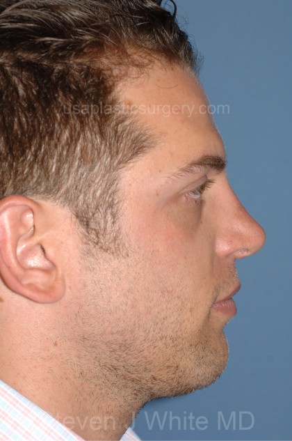 Nose Surgery - Rhinoplasty - Revision Before & After Patient #4088