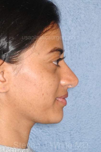 Nose Surgery - Rhinoplasty - Primary Before & After Patient #3859