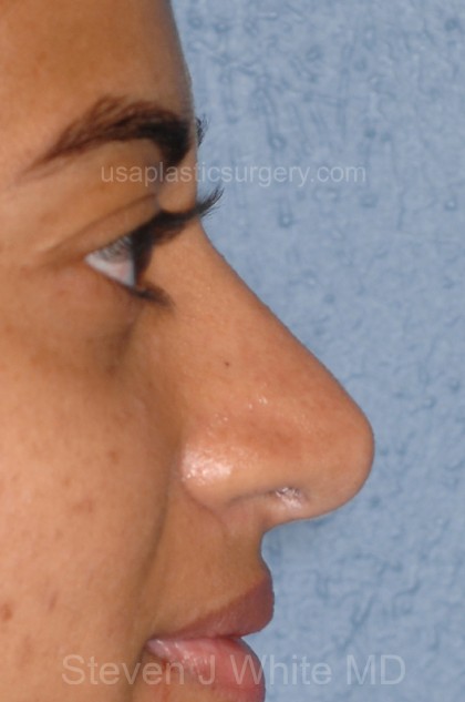 Nose Surgery - Rhinoplasty - Primary Before & After Patient #3859