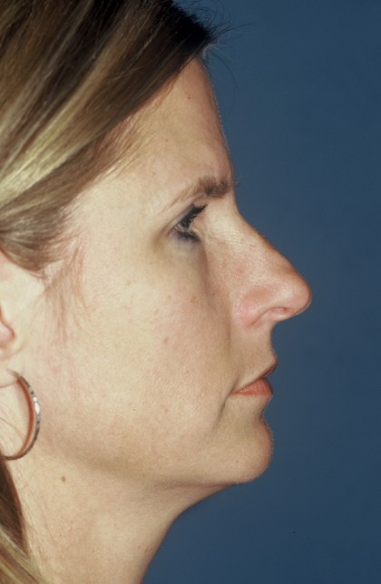 Nose Surgery - Rhinoplasty - Primary Before & After Patient #3880