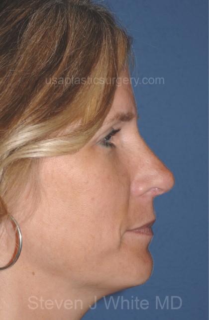 Nose Surgery - Rhinoplasty - Primary Before & After Patient #3880