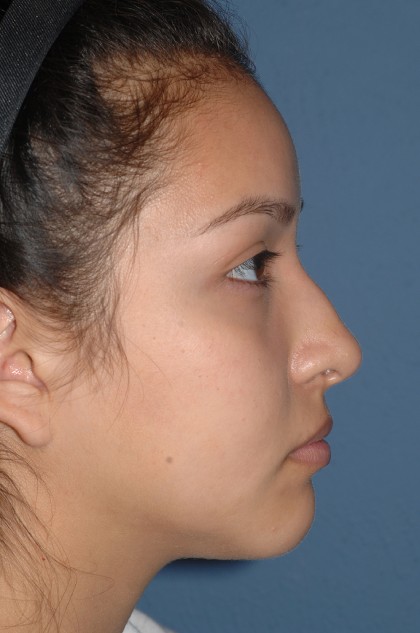 Nose Surgery - Rhinoplasty - Primary Before & After Patient #3971