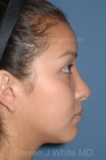 Nose Surgery - Rhinoplasty - Primary Before & After Patient #3971