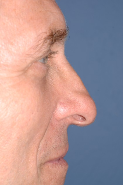 Nose Surgery - Rhinoplasty - Primary Before & After Patient #3972