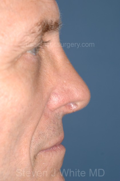 Nose Surgery - Rhinoplasty - Primary Before & After Patient #3972