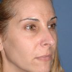 Nose Surgery - Rhinoplasty - Primary Before & After Patient #3973