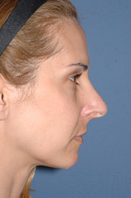 Nose Surgery - Rhinoplasty - Primary Before & After Patient #3973
