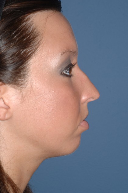 Nose Surgery - Rhinoplasty - Primary Before & After Patient #3974