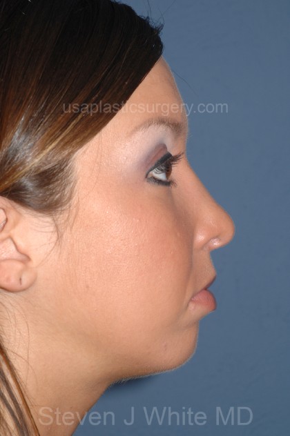 Nose Surgery - Rhinoplasty - Primary Before & After Patient #3974