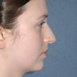 Nose Surgery - Rhinoplasty - Primary Before & After Patient #3975