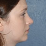 Nose Surgery - Rhinoplasty - Primary Before & After Patient #3975