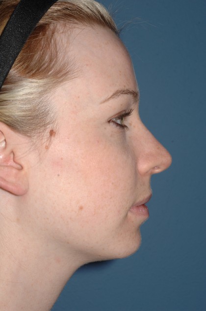 Nose Surgery - Rhinoplasty - Primary Before & After Patient #3976