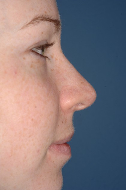 Nose Surgery - Rhinoplasty - Primary Before & After Patient #3976