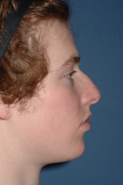 Nose Surgery - Rhinoplasty - Primary Before & After Patient #3977