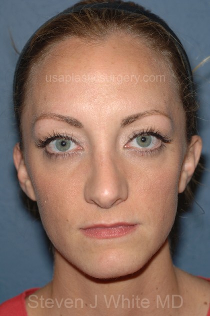 Nose Surgery - Rhinoplasty - Primary Before & After Patient #3978