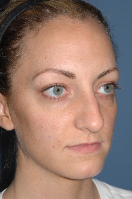 Nose Surgery - Rhinoplasty - Primary Before & After Patient #3978