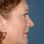 Nose Surgery - Rhinoplasty - Primary Before & After Patient #3979