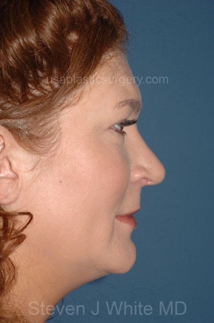 Nose Surgery - Rhinoplasty - Primary Before & After Patient #3979