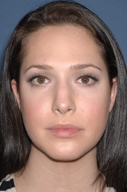 Nose Surgery - Rhinoplasty - Primary Before & After Patient #3872