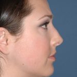 Nose Surgery - Rhinoplasty - Primary Before & After Patient #3872
