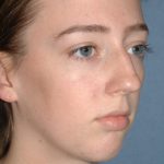 Nose Surgery - Rhinoplasty - Primary Before & After Patient #3980