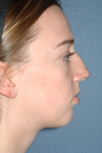 Nose Surgery - Rhinoplasty - Primary Before & After Patient #3980
