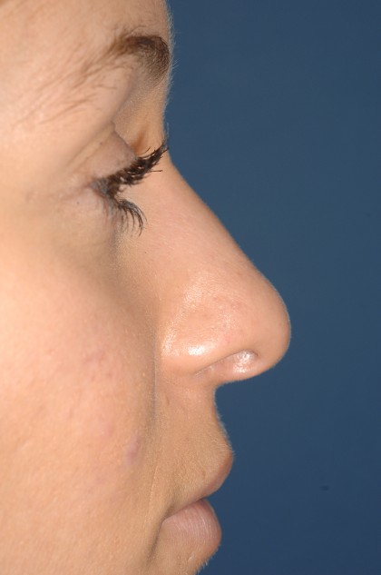 Nose Surgery - Rhinoplasty - Primary Before & After Patient #3873