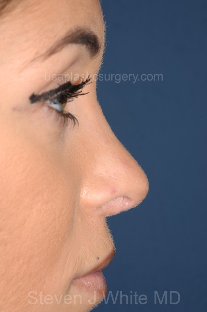 Nose Surgery - Rhinoplasty - Primary Before & After Patient #3873