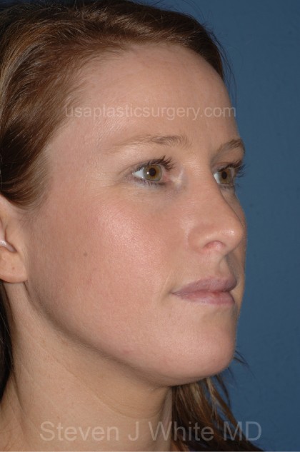 Nose Surgery - Rhinoplasty - Primary Before & After Patient #3874