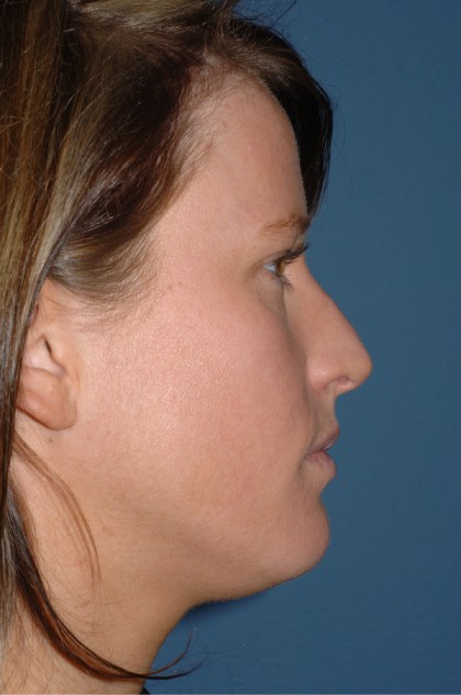 Nose Surgery - Rhinoplasty - Primary Before & After Patient #3874