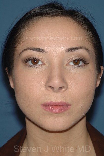 Nose Surgery - Rhinoplasty - Primary Before & After Patient #3875