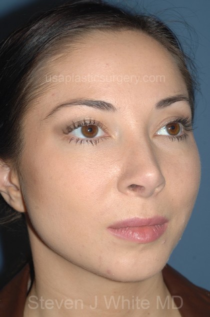 Nose Surgery - Rhinoplasty - Primary Before & After Patient #3875