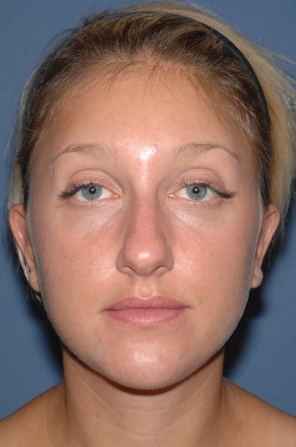Nose Surgery - Rhinoplasty - Primary Before & After Patient #3876