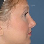 Nose Surgery - Rhinoplasty - Primary Before & After Patient #3876