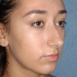 Nose Surgery - Rhinoplasty - Primary Before & After Patient #3877