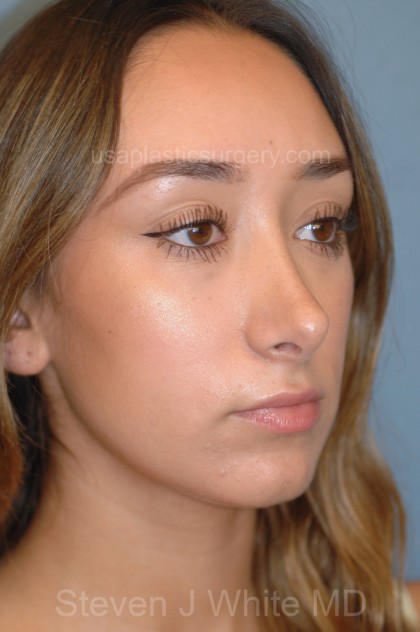 Nose Surgery - Rhinoplasty - Primary Before & After Patient #3877