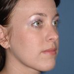 Nose Surgery - Rhinoplasty - Primary Before & After Patient #3878