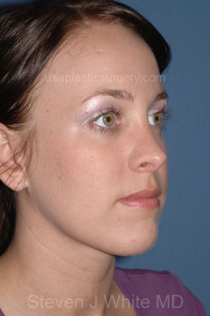 Nose Surgery - Rhinoplasty - Primary Before & After Patient #3878