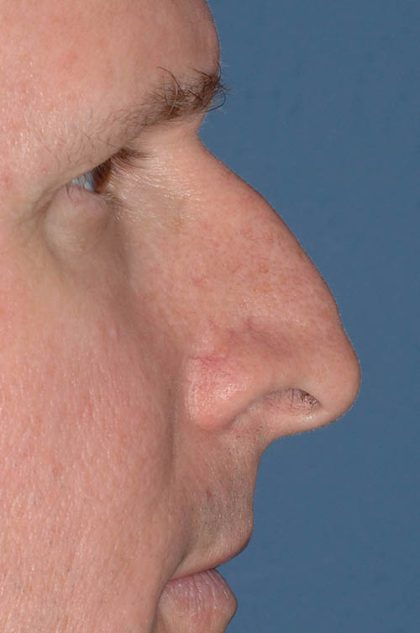 Nose Surgery - Rhinoplasty - Primary Before & After Patient #3879