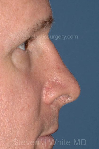 Nose Surgery - Rhinoplasty - Primary Before & After Patient #3879