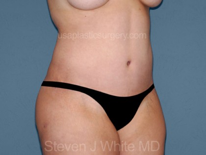 Tummy Tuck - Abdominoplasty Before & After Patient #3315